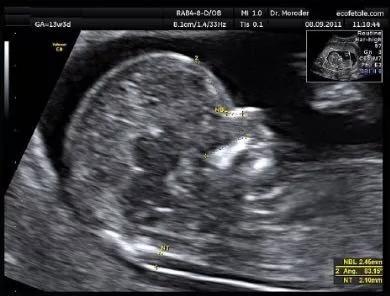 孕妇做完nt下一步做什么检查,孕妇做nt检查可以吃早餐吗