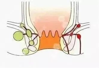 肛瘘是常见病吗？肛瘘有几种？