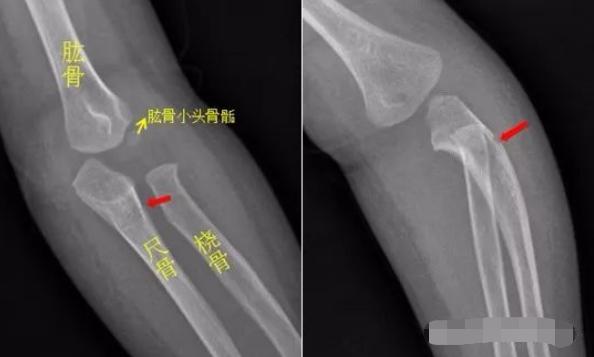 怎样发现骨折的可能性,一招看出手指骨折