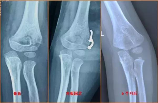 孩子胳膊向外弯怎么回事,小孩胳膊肘往内拐什么原因