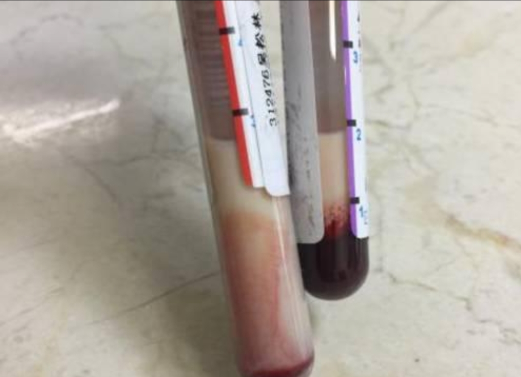 抽血发现血颜色发黑怎么回事,抽血颜色发黑是不是有毒素