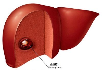 肝血管瘤的诊断和治疗方法,超声造影诊断肝血管瘤