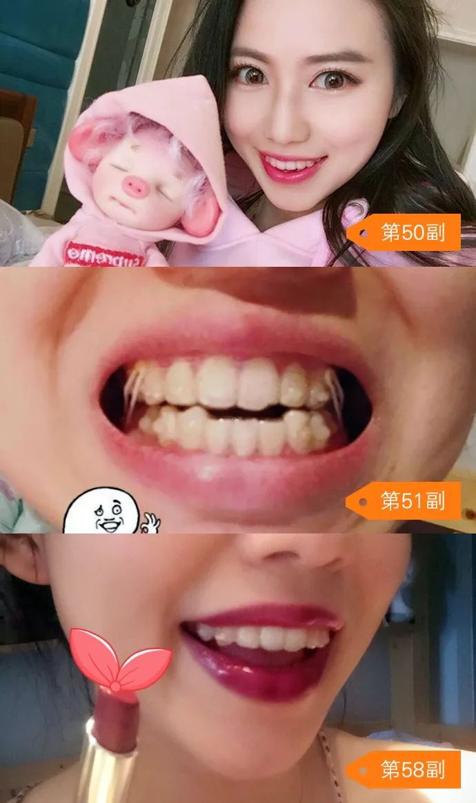 龅牙矫正前后对比照片,龅牙修复效果图