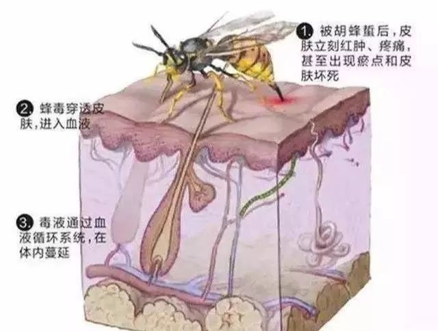 被马蜂蛰过敏性休克的急救措施,儿童被马蜂蛰了看不到毒刺