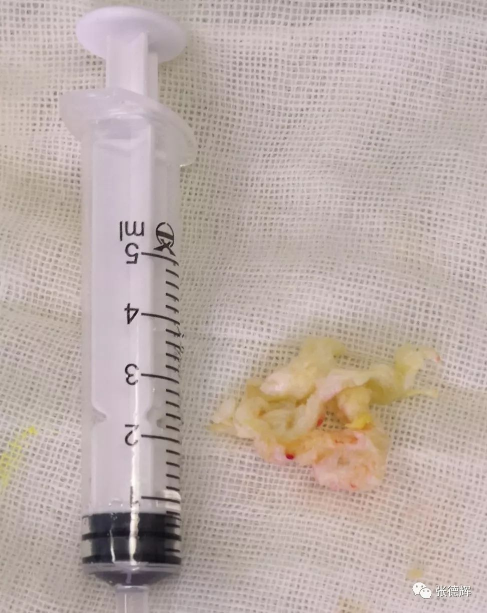 巨大腰间盘突出可以保守治疗吗,腰椎间盘突出不治疗越来越严重