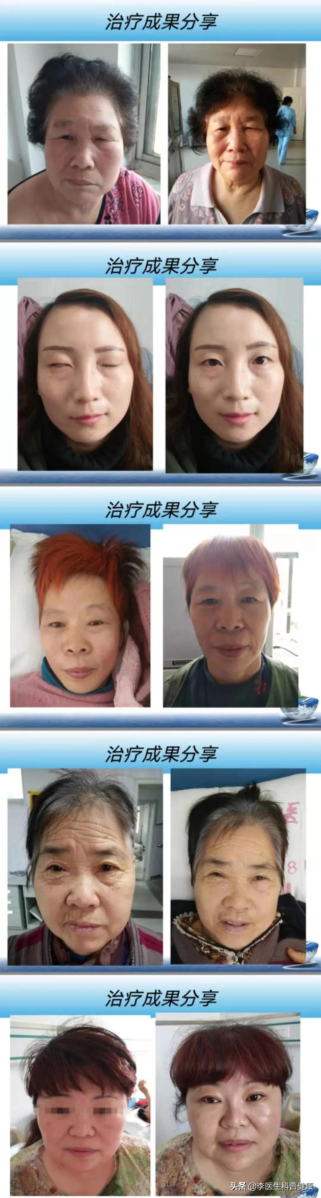 面部吹点冷风，发现眼睛闭不上了，嘴巴也歪了，到底是咋回事儿？