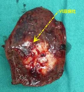 县中医院首例腹腔镜手术圆满成功,直肠癌腹腔镜手术成功案例