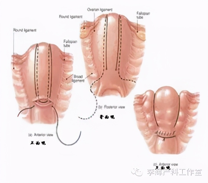 子宫收缩乏力引起产后出血的综述,宫缩乏力性产后出血的诊治建议