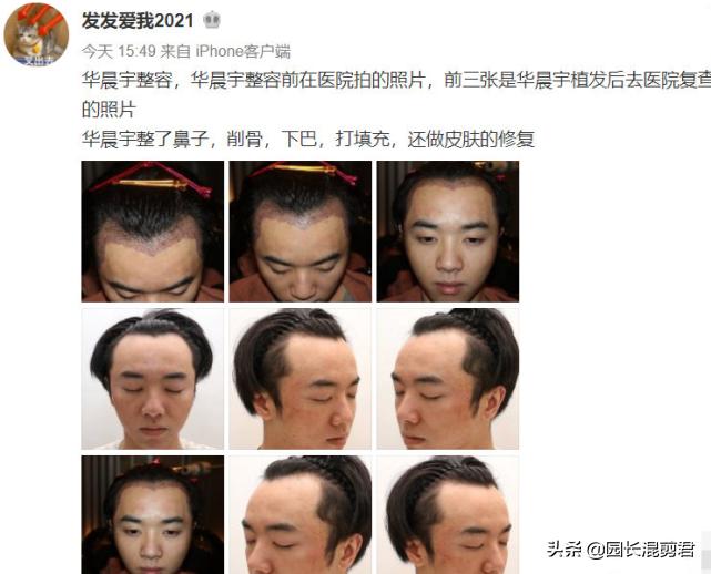 华晨宇回应植发,曝华晨宇植发真的假的