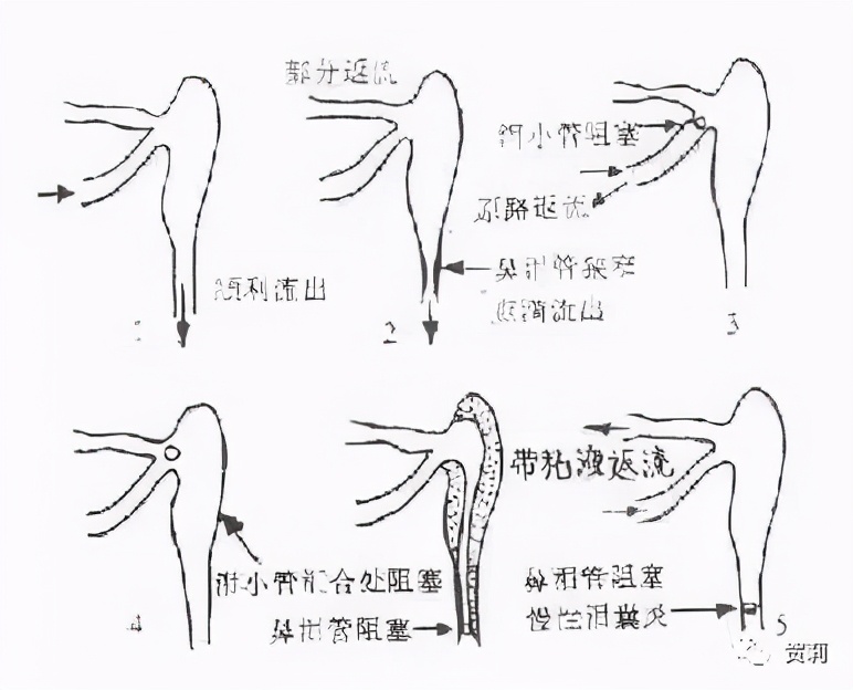 泪道狭窄和阻塞的相关知识,泪道狭窄阻塞怎么治