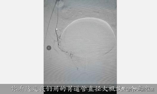 医生给你用图片讲解：前列腺增生如何微创治疗，一看就懂！