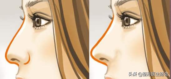 鼻子高的人正面看不是很好看,过于高挺突兀的鼻子