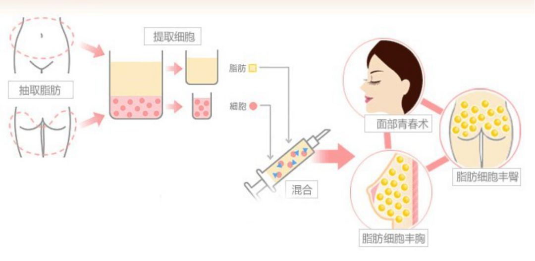 娄艺潇填充脂肪前后对比,娄艺潇填充前后对比