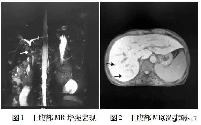 【罕少见病例】罕见“三重综合征”1例并文献复习