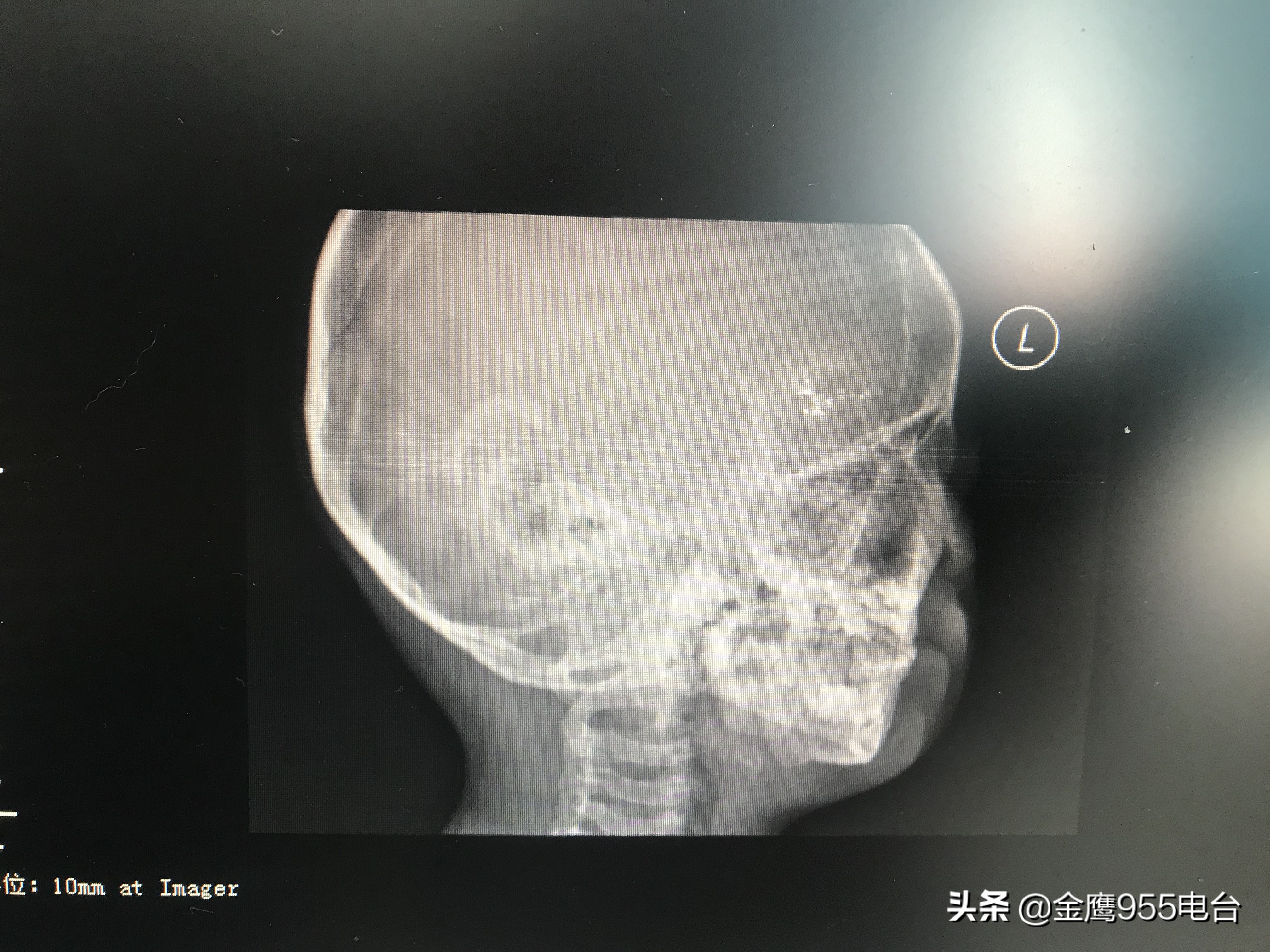 家长注意了!男孩不慎摔倒温度计插入眼眶三年驱汞治疗仍有残余