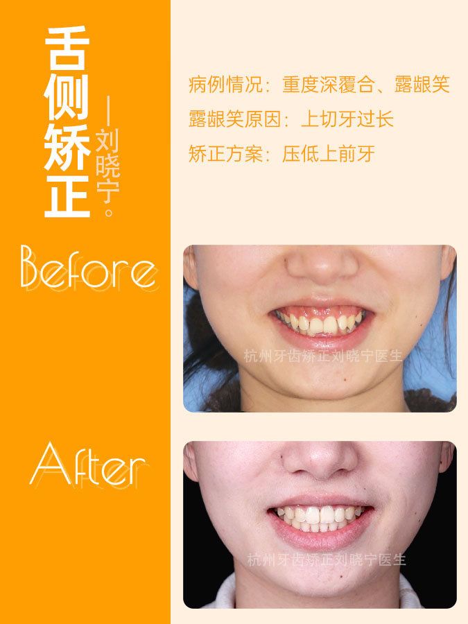 杭州牙齿矫正丨露龈笑怎么办?全面告别露龈笑的4大方法