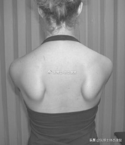 体态矫正翼状肩胛训练,翼状肩胛骨如何矫正