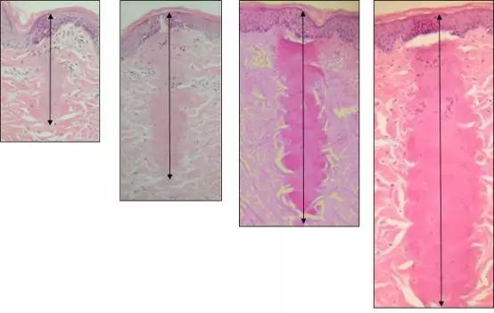 激光祛疤的原理是什么,激光祛疤原理是什么