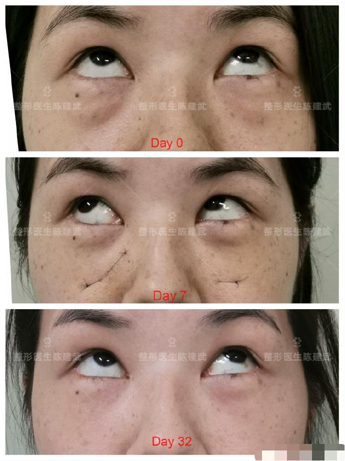 牙膏跟盐水能去眼袋吗,牙膏涂抹能祛眼袋