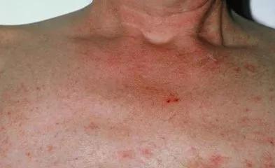 39岁男子查出肝癌,35岁男子查出肝癌身上有特殊记号