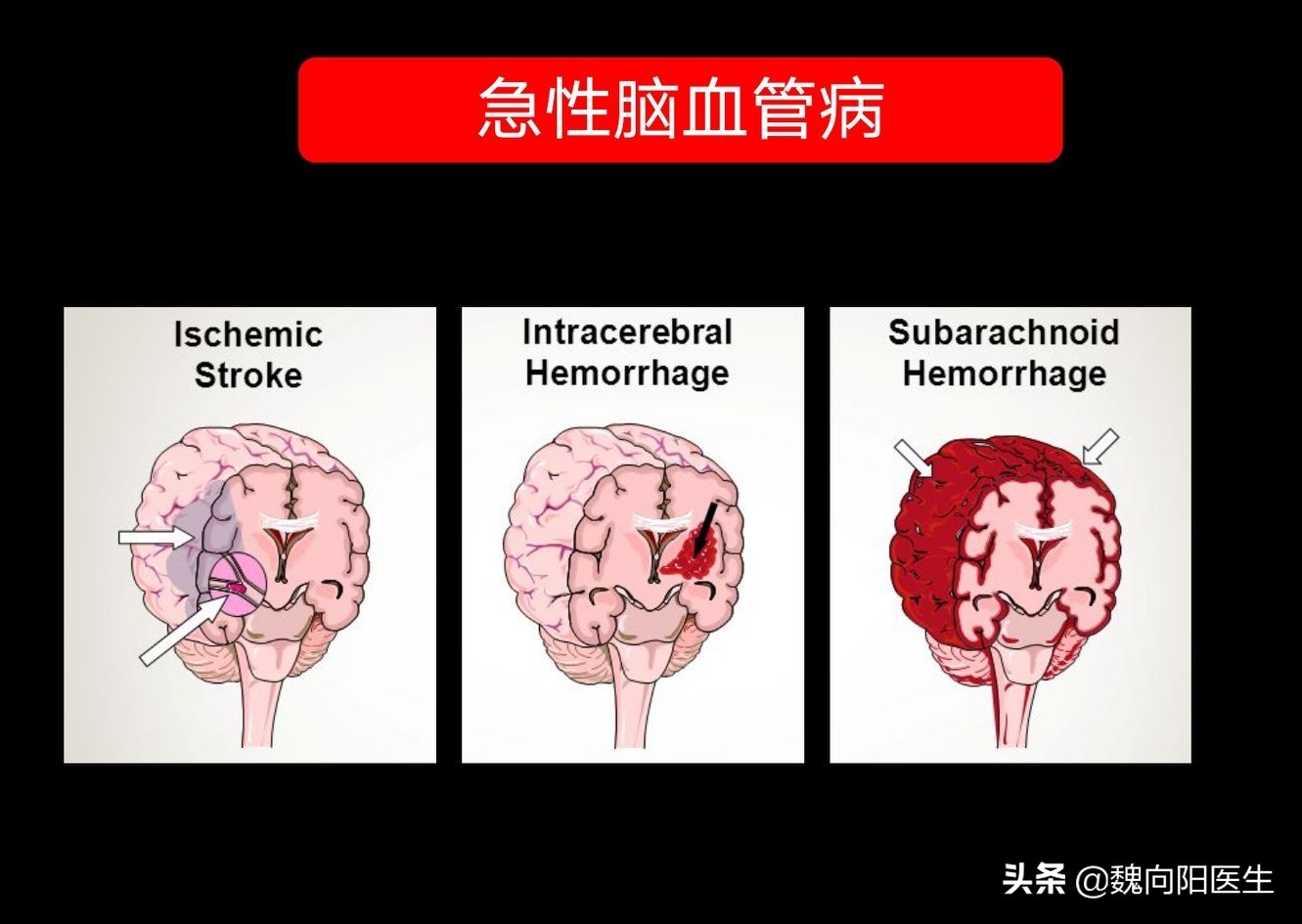 脑供血不足头晕输液用什么药,头晕眩晕需要输液吗