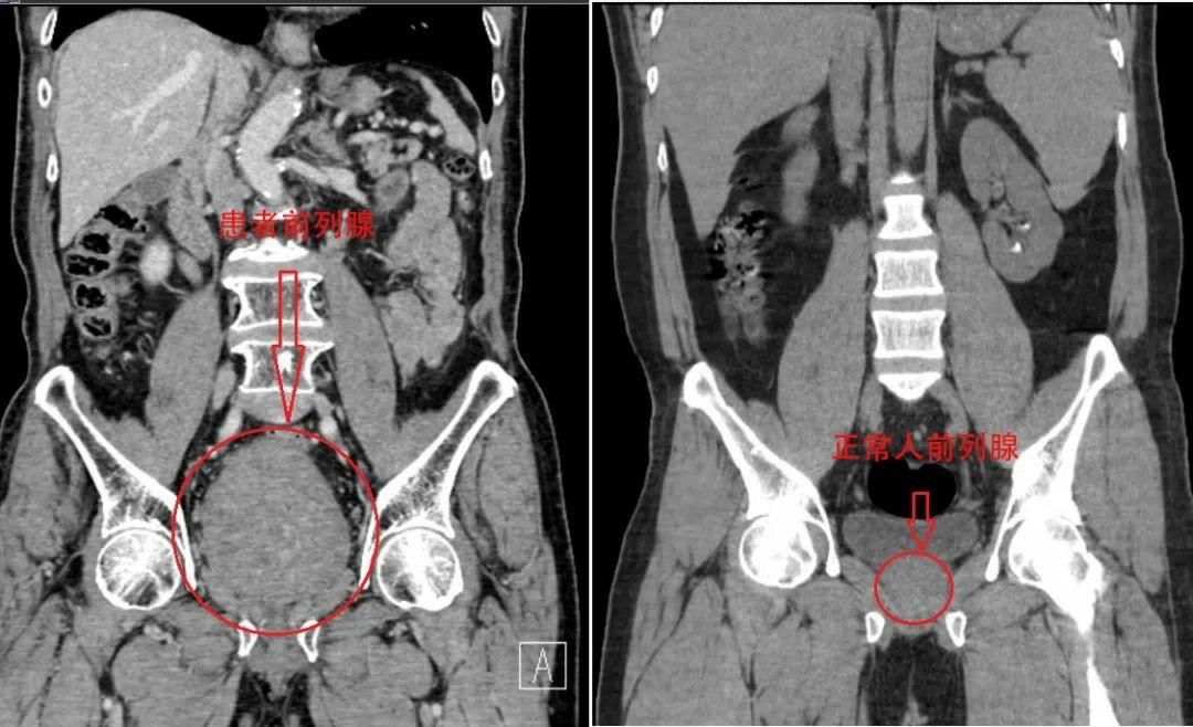 老人前列腺增生用做微创吗,高龄前列腺增生手术出血多