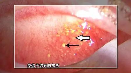 为什么长结石的人会反复长结石,眼睛反复长结石是什么原因