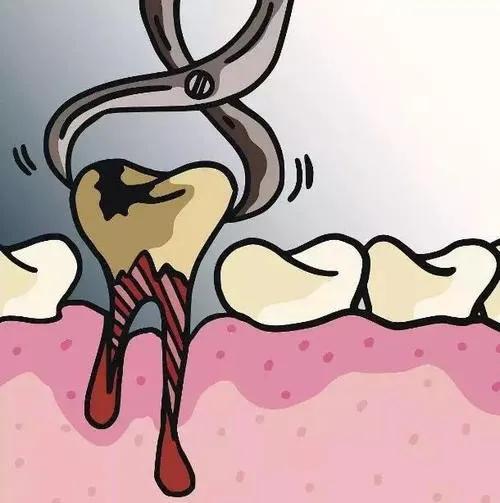 牙医拔牙的几种方法,作为牙医会拔牙是不是基本操作