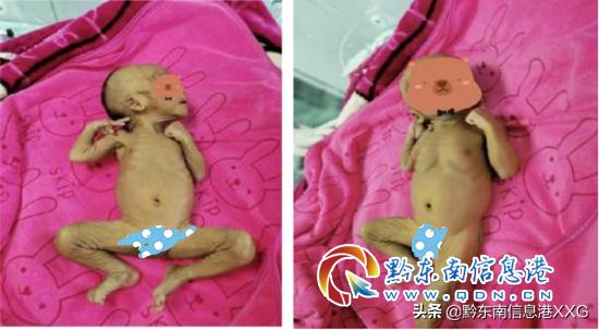 皮包骨变萌娃！丹寨县人民医院成功救治一名重度营养不良患儿