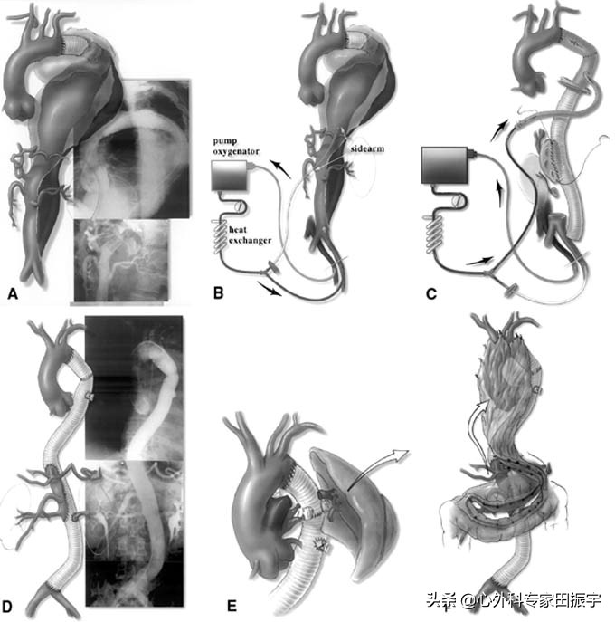 胸主动脉瘤最常见的护理措施,胸主动脉疾病