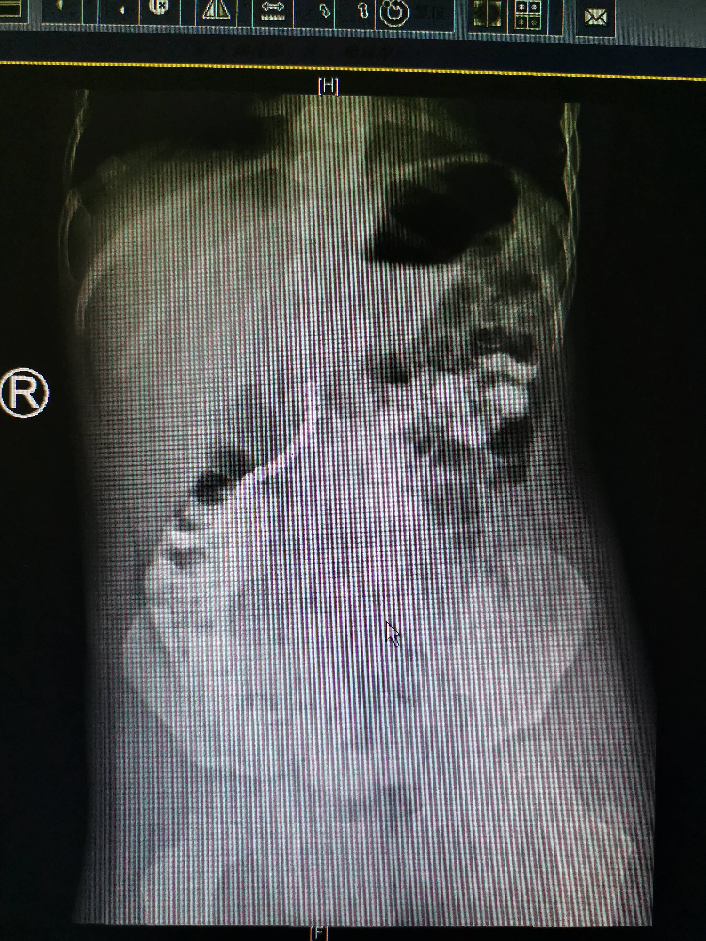 男童误吞11颗磁力珠后来怎么处理,男童误吞11颗磁力珠新闻