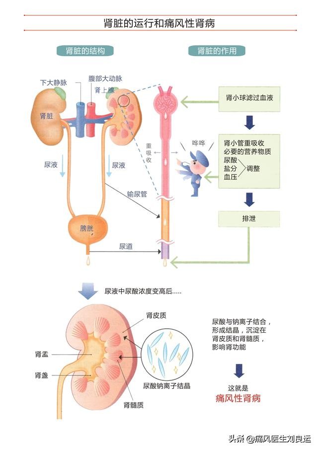 快速降尿酸治痛风的处方,痛风降尿酸中药靠谱吗