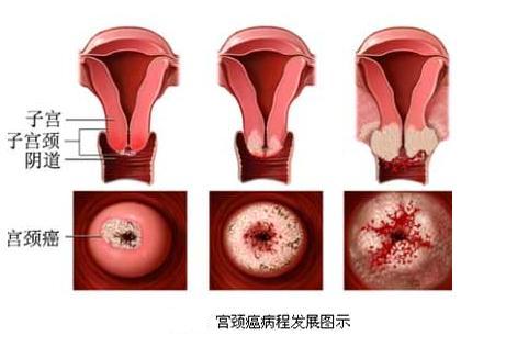 绝经后出血警惕四种疾病,绝经后出血当心卵巢癌