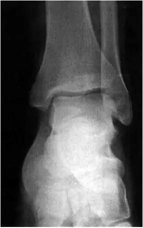 踝关节撞击症问诊,踝关节内侧撞击综合症位置图