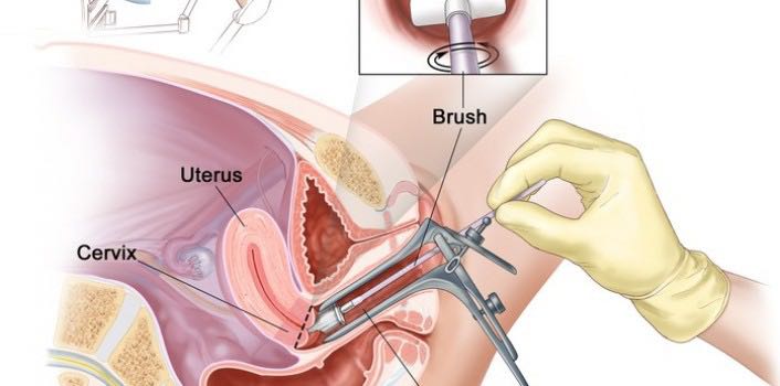 体检每次都查的HPV,你真的正确对待了吗?