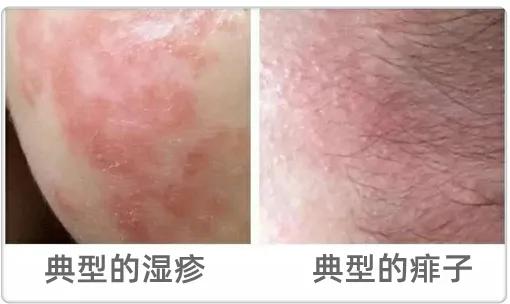 爽身粉去热痱子,长痱子用爽身粉可以去痱子吗