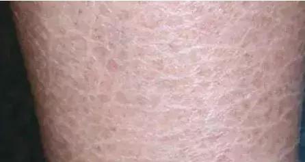 为啥脚后跟干裂起鱼鳞皮,脚后跟干裂小腿长鱼鳞