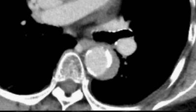 肠系膜上动脉夹层,心脏动脉夹层破裂