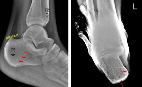 怎样发现骨折的可能性,一招看出手指骨折