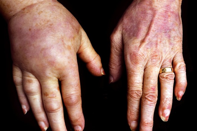 手指头肿了需要去医院吗,单个手指头肿胀要警惕四种病