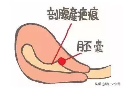 胚胎在疤痕上如何清除,胚胎落在子宫疤痕上怎么办