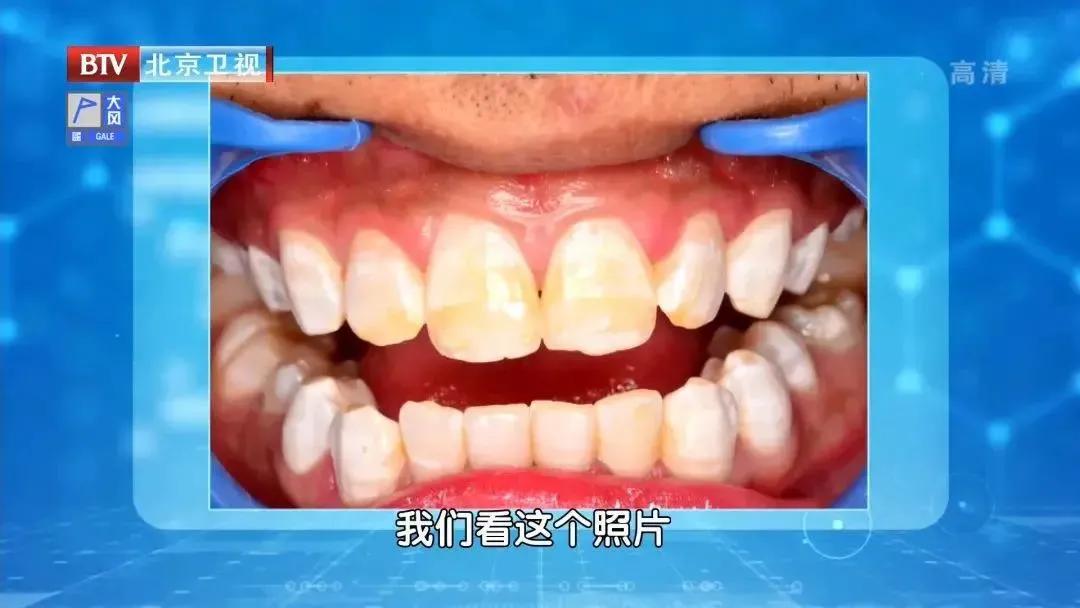 吃饭老塞牙缝怎么治疗,吃饭总塞牙你知道问题出在哪里吗