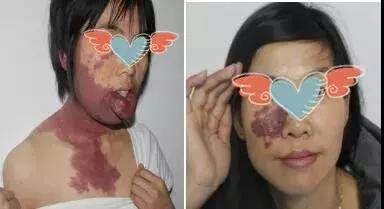 激光治疗红胎记几天能恢复,小孩身上长红胎记怎么回事