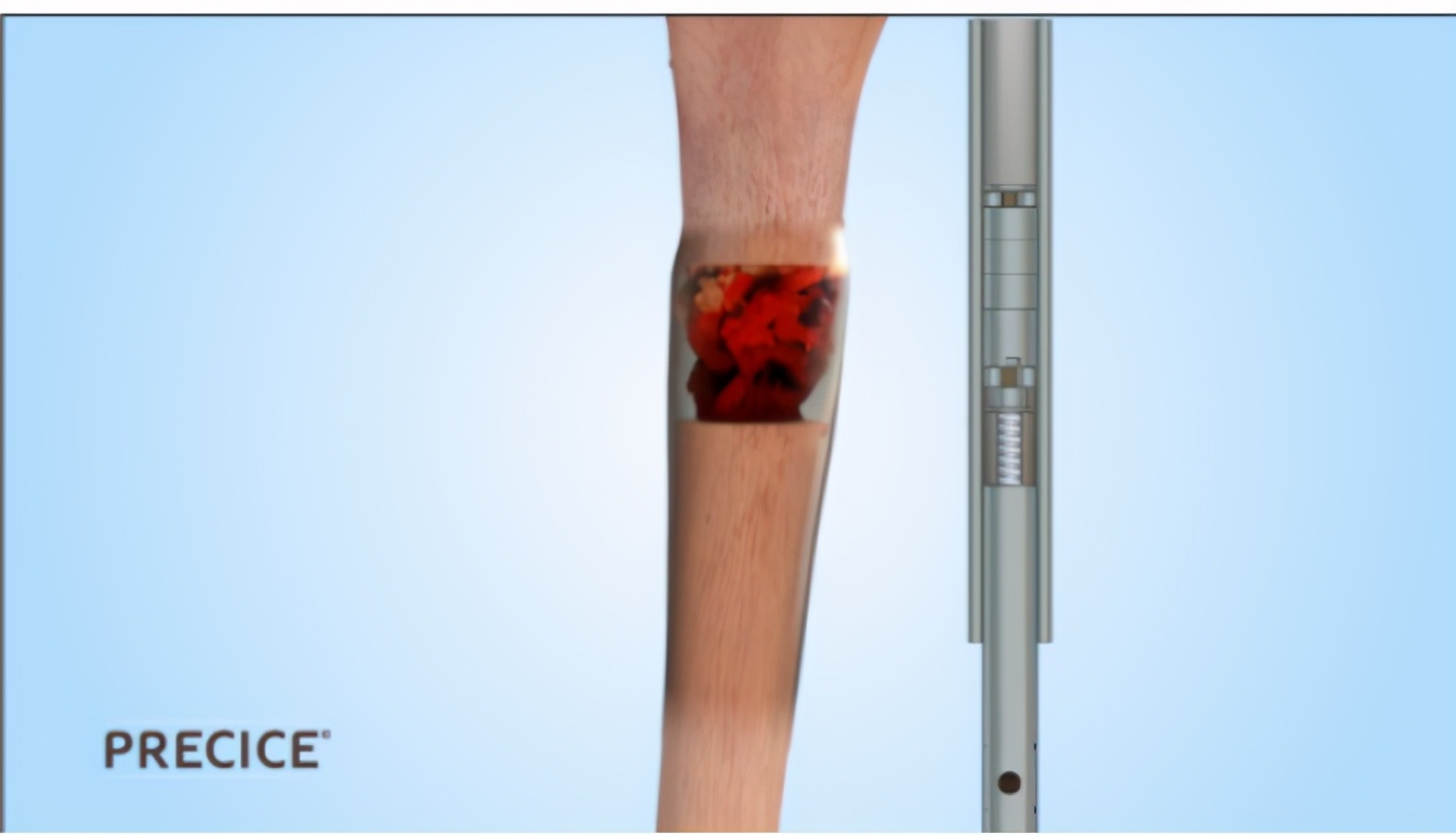 这一产品停止植入!FDA警告全球第三大脊柱医械公司