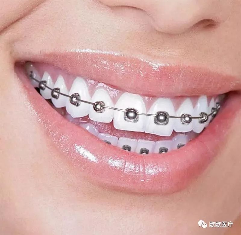 补牙戴牙套后注意事项,戴牙套吃东西要注意什么