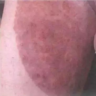 科普真菌感染性皮肤病的防治,专门治疗真菌皮肤病的药膏