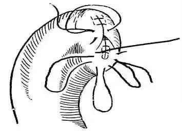 外科8种缝合方法图解,外科基本缝合方法实验报告