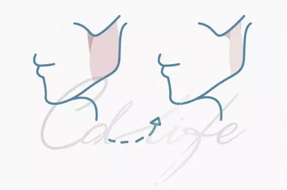 隐形牙套怎么让牙齿变好看,怎么弄隐形牙套