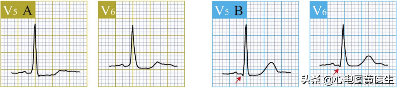 心电图q波异常但冠脉造影正常,病理性q波与异常q波心电图