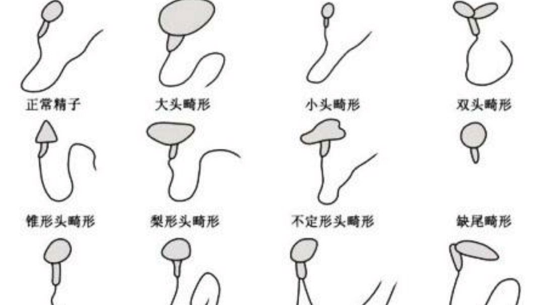 畸形精子症怎么治疗有效,精子畸形症怎么治疗